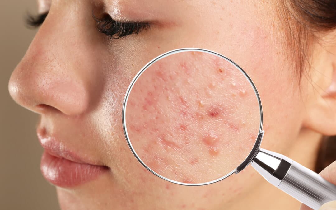 How to Treat Hormonal Acne Naturally? Tips From Expert Dermatologists