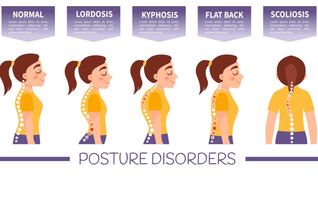 Posture Types & Proven Tips to Correct Bad Posture