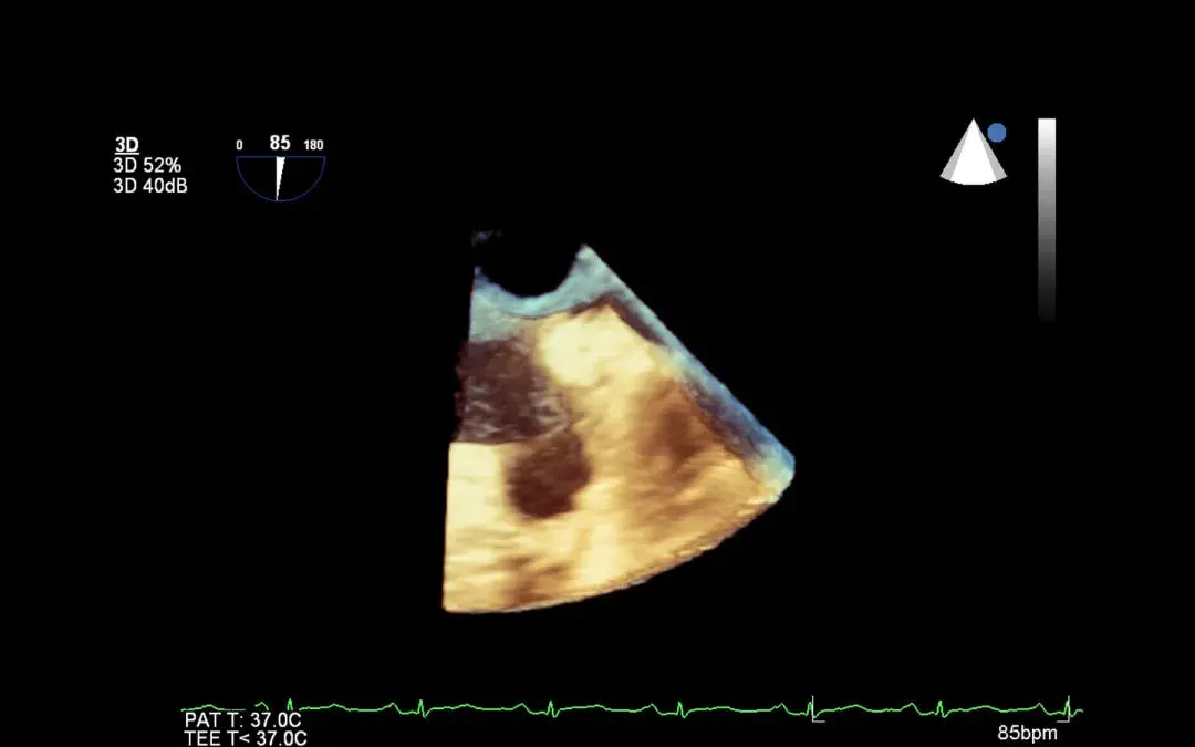 All about 3D echo test: Why it’s Performed, Test Procedure, Preparation for the test, and more