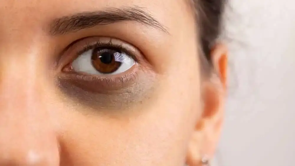 Dark Circle Problems? Our Dermatologists have the perfect solution!