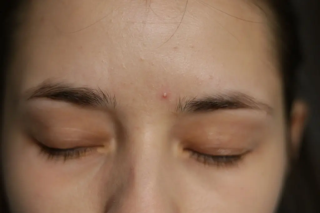 Acne between eyebrows Causes, Treatment, and Prevention MFine