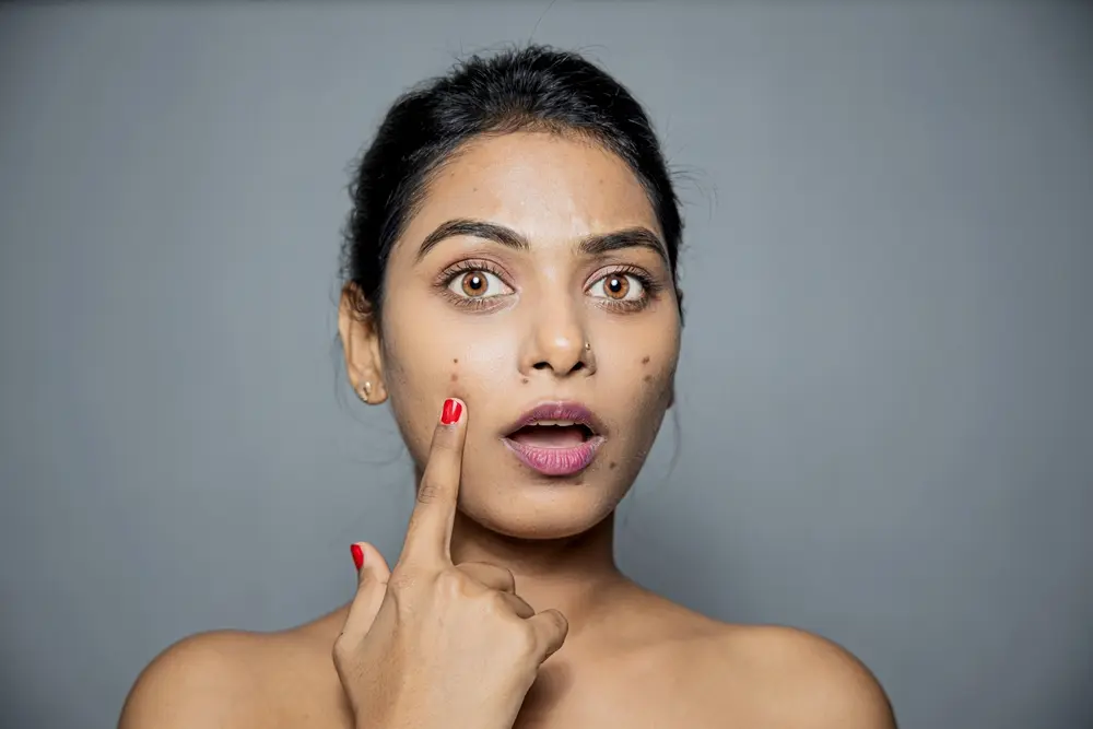 Over-the-Counter vs. Prescription Acne Treatments