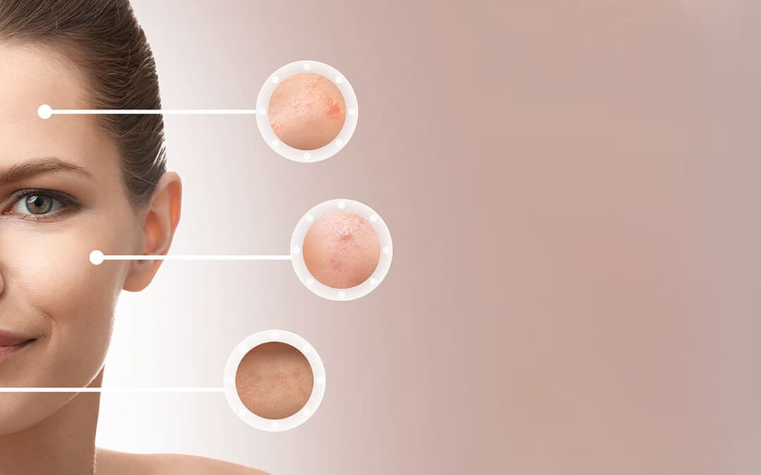 6 Effective Acne Scars Treatments Approved by Dermatologists