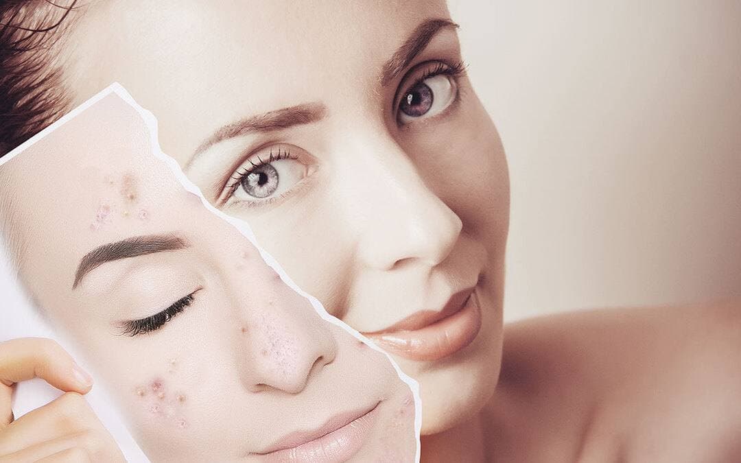 Don't Stress! Treat Acne the Right Way