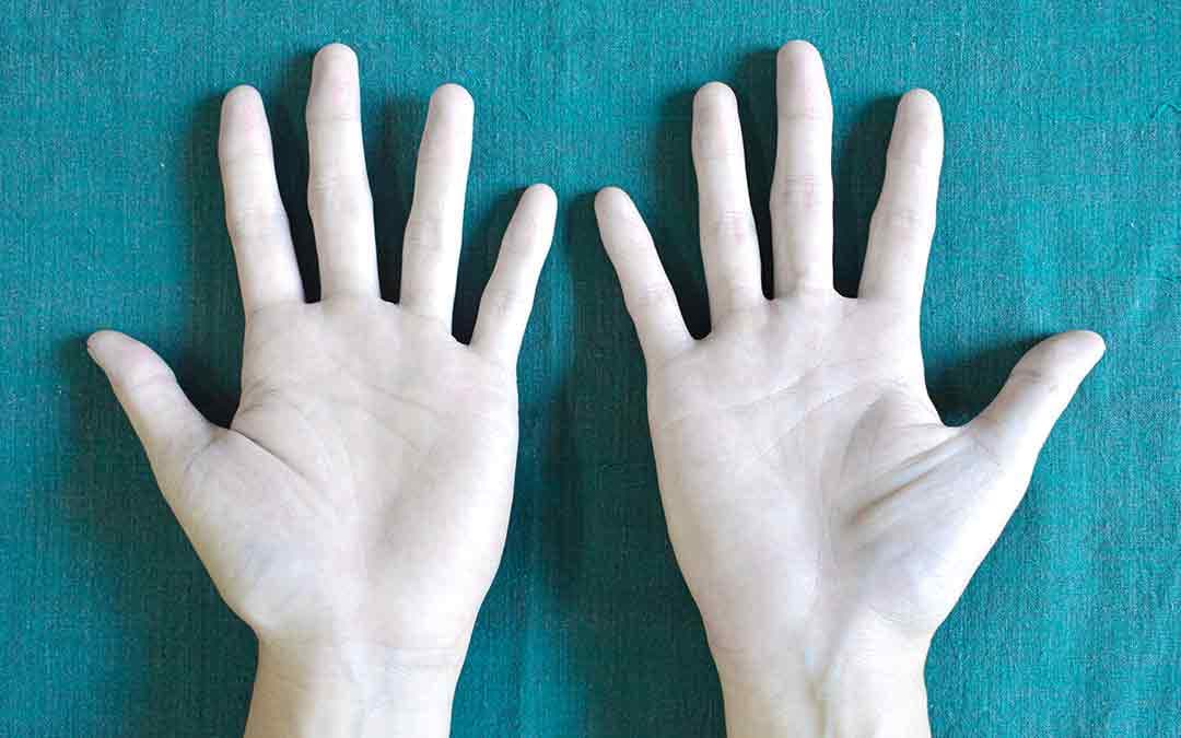 All You Need To Know About Iron Deficiency