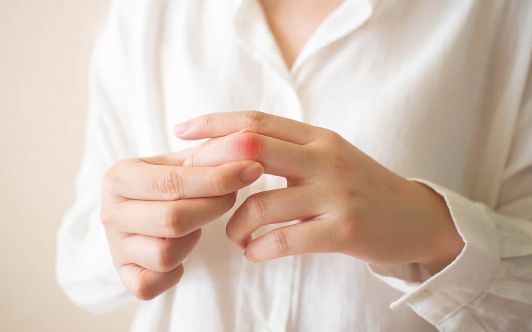 What Is It Like To Live With Lupus, An Autoimmune Disease