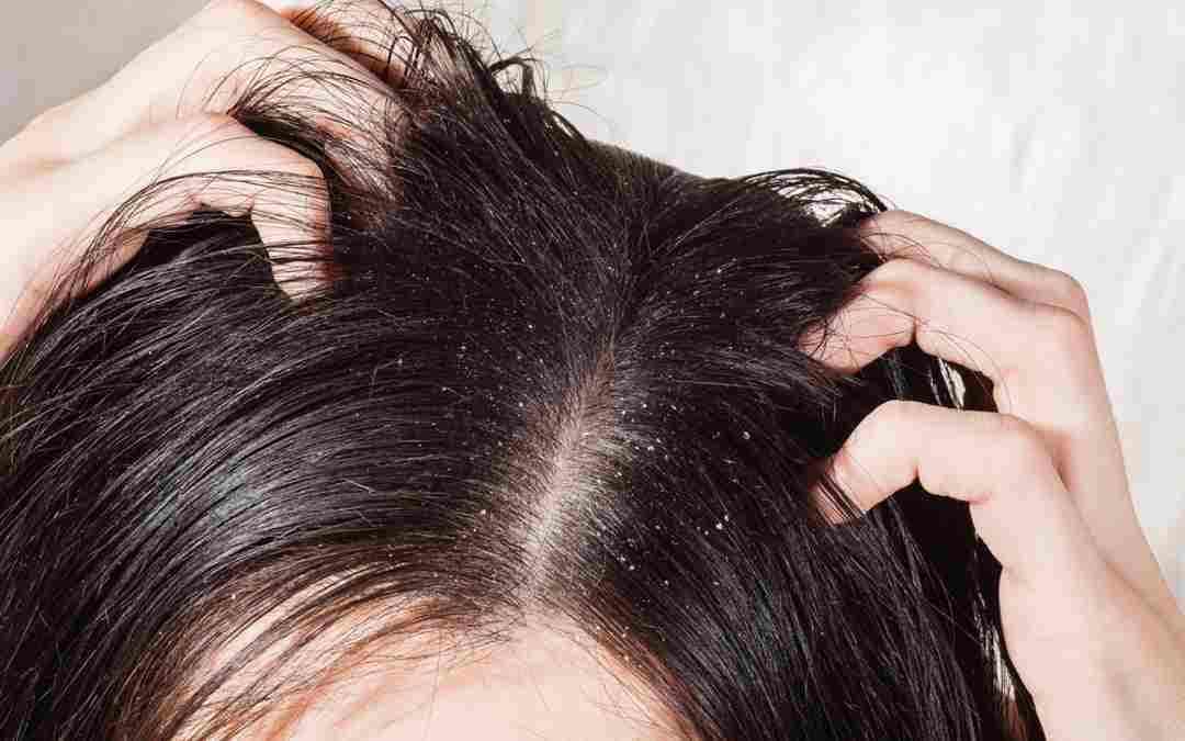 Causes and Treatment of Dandruff: Ditch The Itch & The Flake