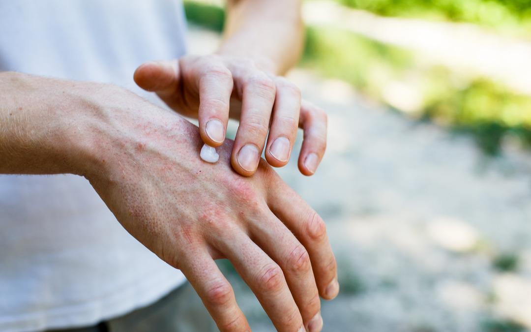 7 types of Psoriasis: Triggers and Symptoms