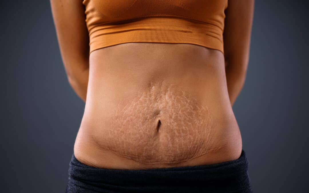 4 Ways To Get Rid Of Belly Bulge After Pregnancy
