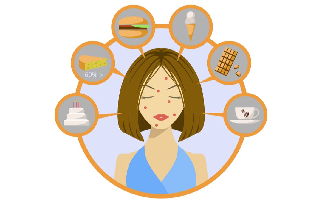 Top 7 Foods That Can Cause Acne