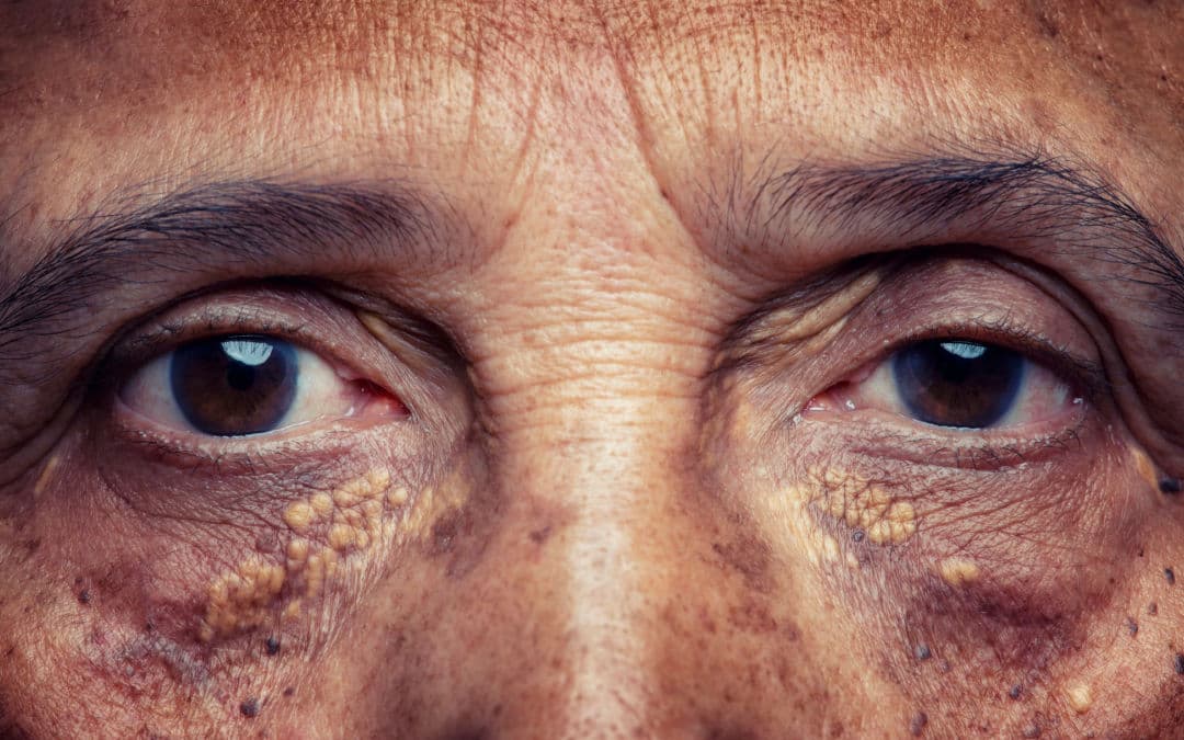 High Cholesterol: Do not ignore these three signs in your eyes