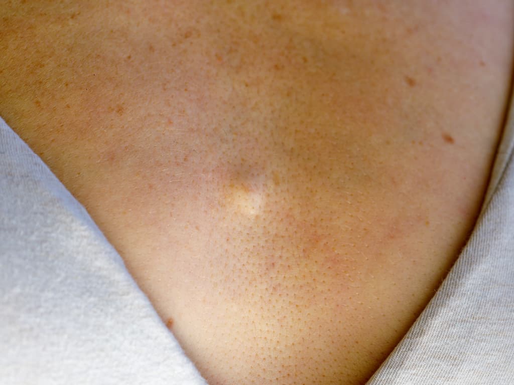 What Is Sebaceous Hyperplasia? Its Causes, Symptoms and Treatment