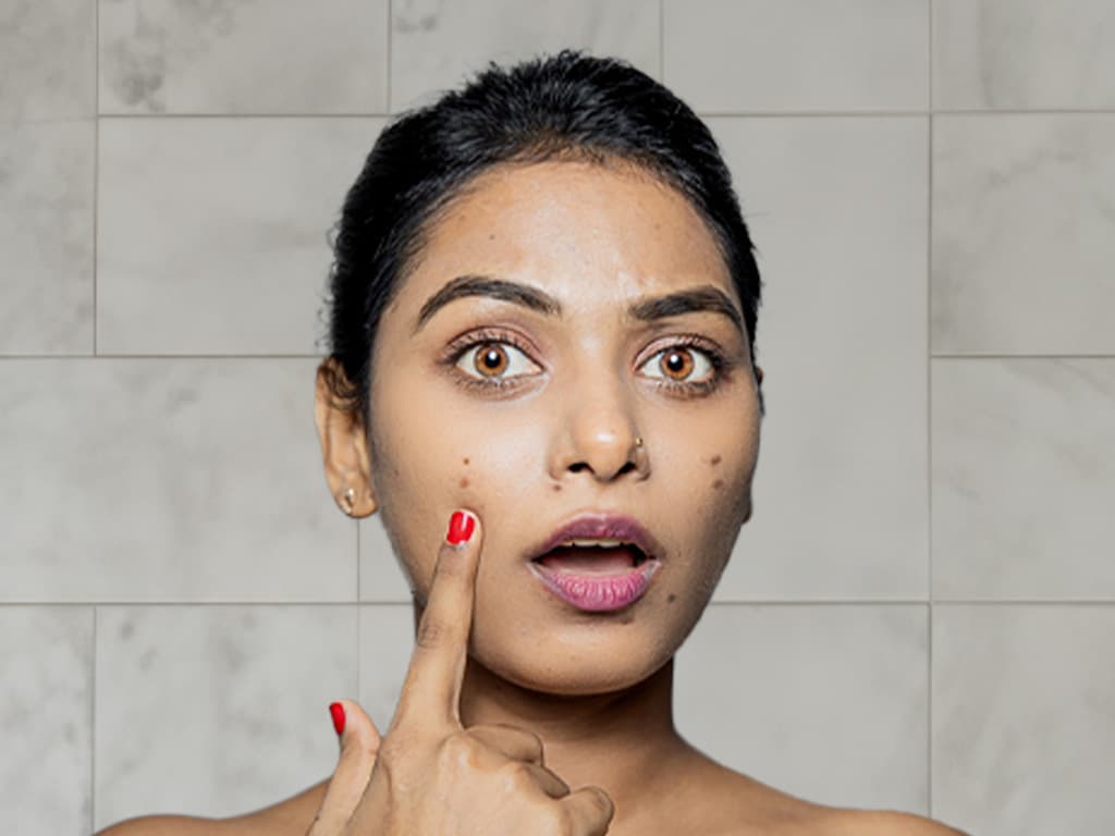 Shocking Truth Revealed: Learn the Difference Between Acne and Pimples!