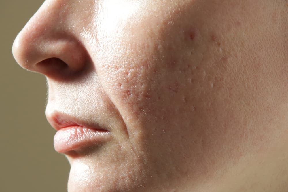 Open Pores Treatment Recommended By Skin Specialists