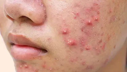 What Are The Causes Of Cystic Acne and How Is It Treated?