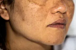 Best Treatment for Melasma on Face Approved by Dermatologists
