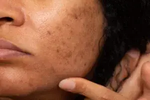Pigmentation Problems? Our Dermatologists have the perfect solution!