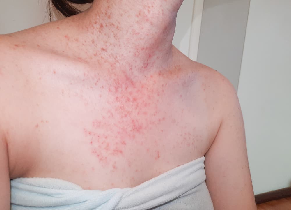 Causes and Treatment of Fungal Acne from a Dermatologist