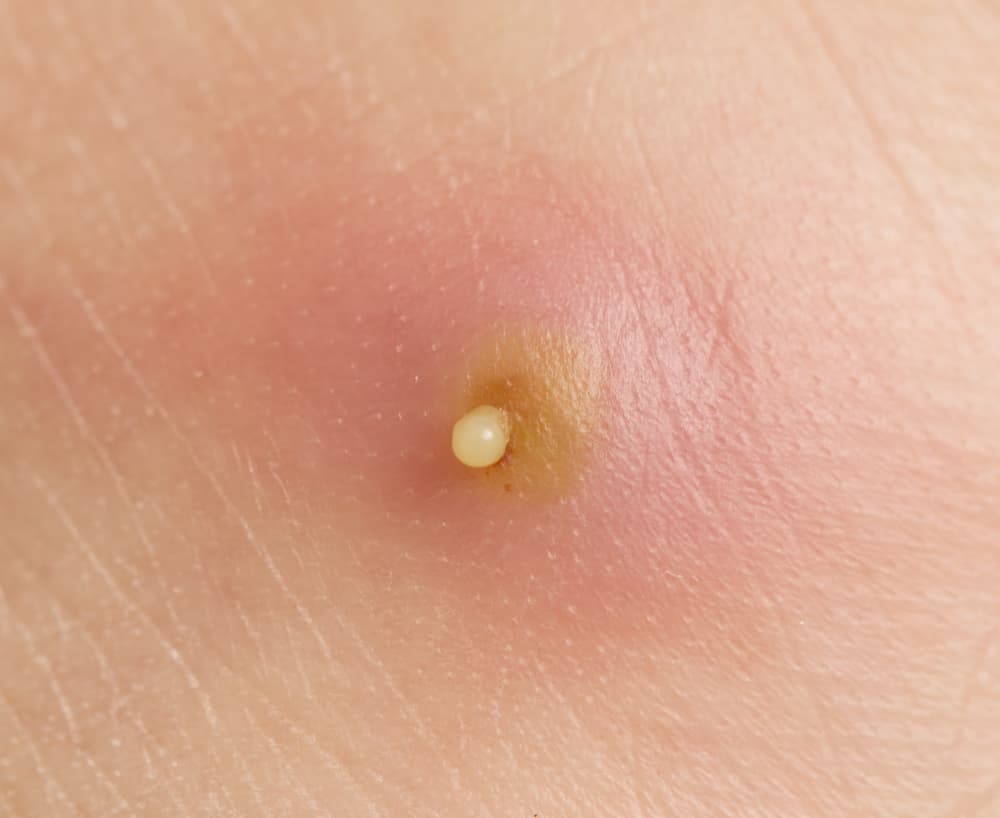 Dermatologist-Approved Treatment To Cure Boils (Baltod) for Clear Skin