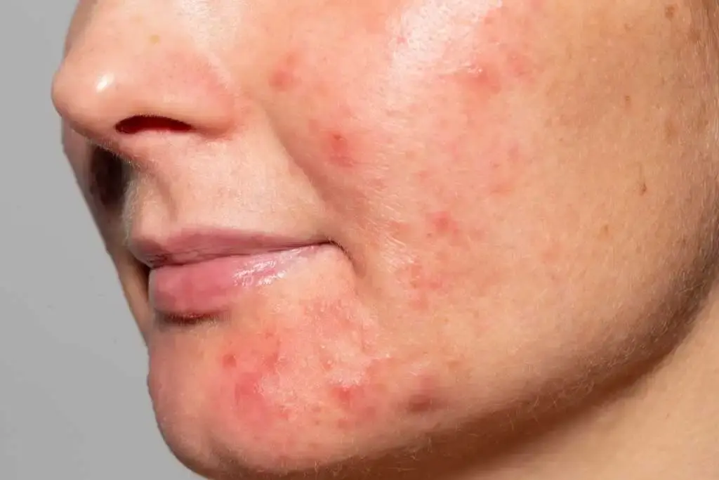 What’s causing acne on your chin?
