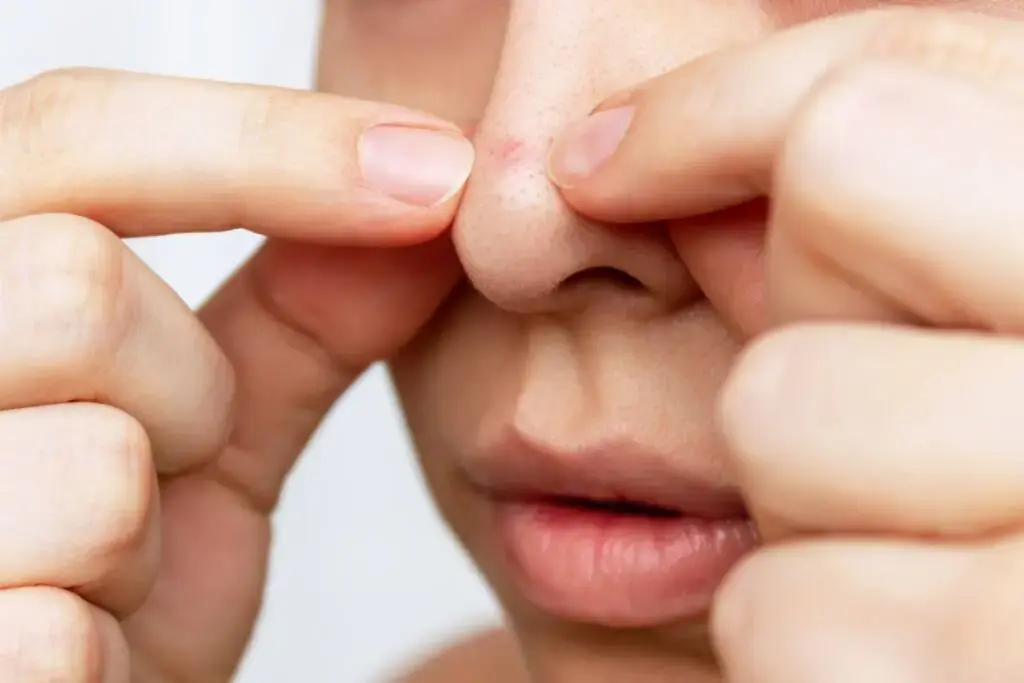Acne on your nose? Causes, types, and treatment solutions.