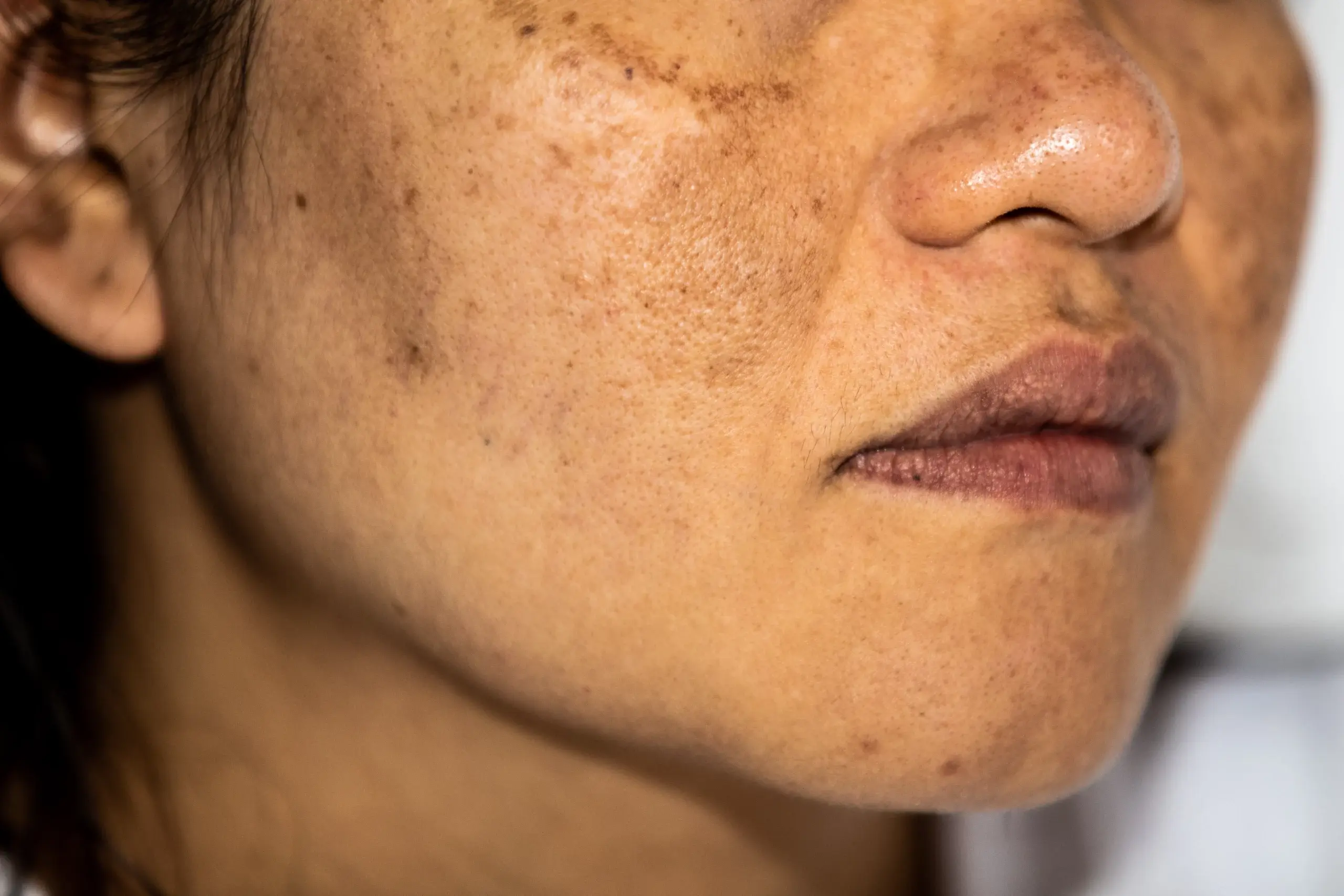 Causes Of Melanin Patches On Skin: How To Reduce Melanin In Skin?