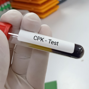 What Is The Difference Between CK And CPK Blood Test, 53% OFF