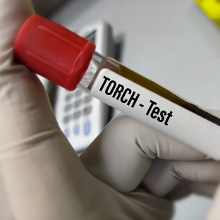 TORCH Test Use, Procedure & Normal Range